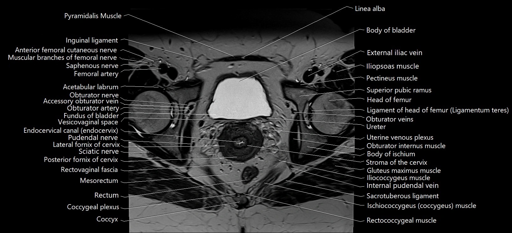 Axial cross sectional anatomy of female pelvis (MRI 3T) image 28.webp